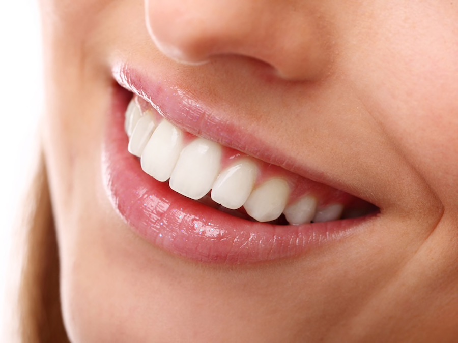 Faccette dentali - la Dr.ssa Maria Chiara Salmi ci spiega cosa sono e a cosa servono