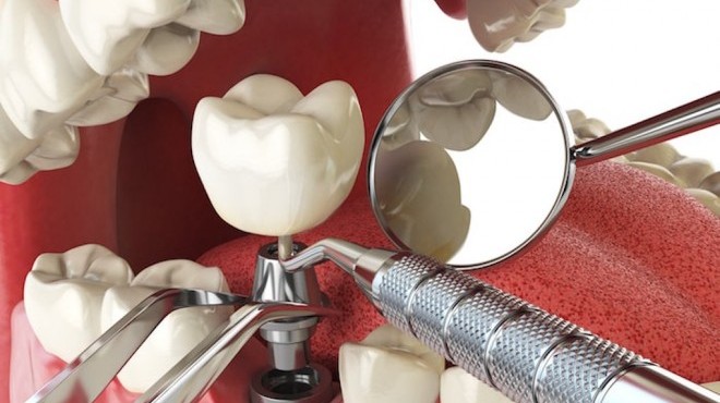 Impianto dentale: come comportarsi dopo l’intervento