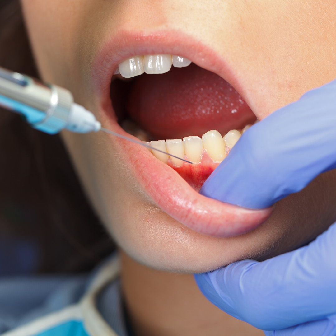 Da gengivite a parodontite: patologie da non sottovalutare 