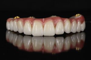 Odontoiatria digitale: all-on-4 con denti fissi