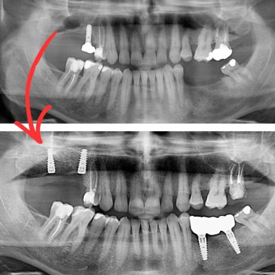 qualita-dell-osso-prima-di-mettere-un-impianto